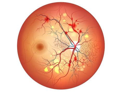 Primer tratamiento para la retinopatía diabetica