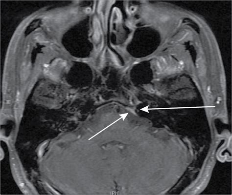 Cranial Nerve Palsy Mri