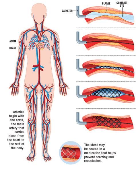 Clearing Clogged Arteries to Protect Your Heart | RWJ University Hospital Hamilton