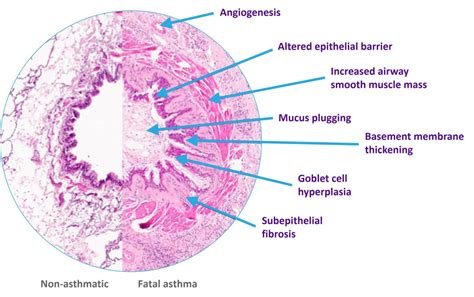 The airway epithelium plays a key role in driving airway remodelling in severe asthma | AZ ...