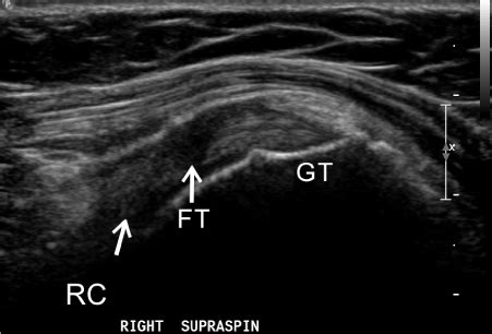 Rotator Cuff Ultrasound Images