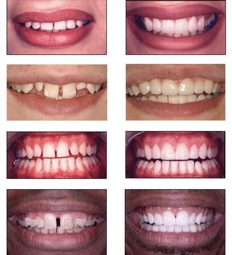 Tooth Gap PNG Transparent Tooth Gap.PNG Images. | PlusPNG