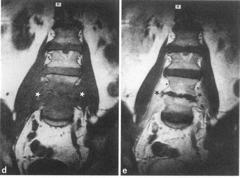 Pyogenic spondylitis of L4-5. a) Sagittal TI-weighted image (TRITE ...