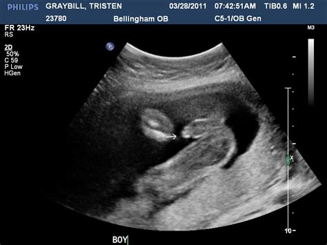 Inside Tristen: 20 Week Ultrasound: ITS A BOY!!