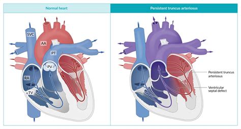 Congenital Heart Defects Diagram