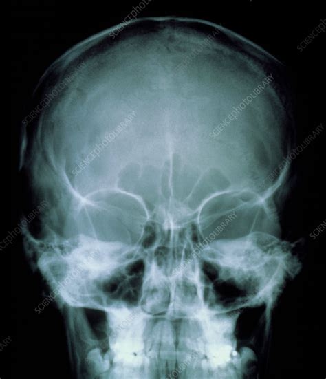 X-ray of the skull front view - Stock Image - P120/0088 - Science Photo Library