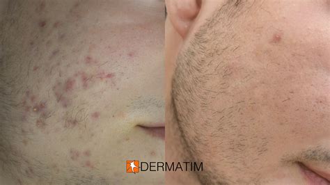 Acne Treatment for Scars | Acne Scars Treatment | Laser for Acne Scars