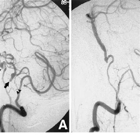 (PDF) Bilateral Anomalous Posterior Inferior Cerebellar Artery-Anterior ...