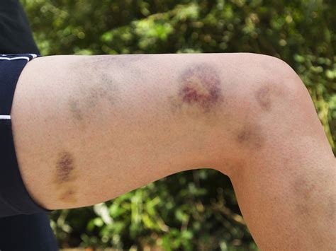 Causes of Easy Bruising: Reasons Why People Bruise Easily