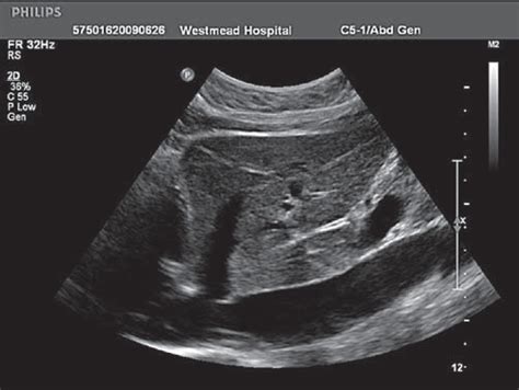 The liver: how we do it - Macnaught - 2009 - Australasian Journal of Ultrasound in Medicine ...