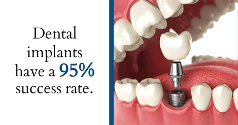 What Is The Success Rate Of Dental Implants?