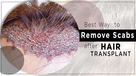 Best Way to Remove Scabs After Hair Transplant | By Dr. Rana Irfan ...