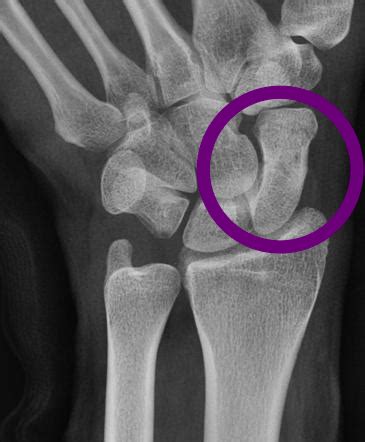 Suspected Scaphoid Fracture - Fracture Info