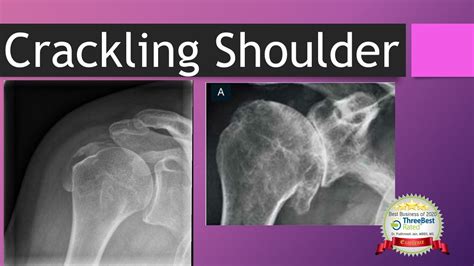 Crackling Shoulder: Noise from Shoulder - YouTube