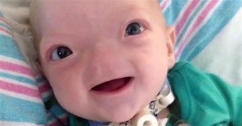 Eli, the 'Miracle Baby' Born Without a Nose, Has Died