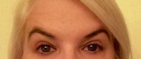 Perfect Botox results