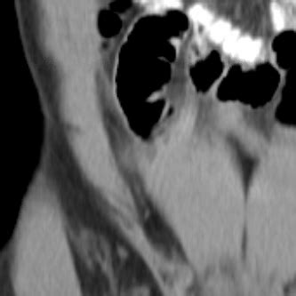 Acute appendicitis | Radiology Case | Radshare.net
