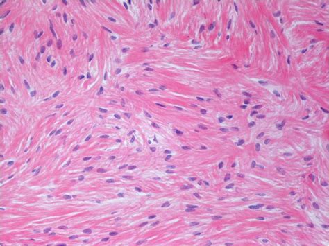 Low Grade Fibromyxoid Sarcoma