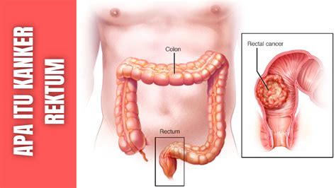 Apa Itu Kanker Rektum : Epidemiologi Kanker Rektum, Faktor Resiko Kanker Rektum - SIPATILMUKU.XYZ
