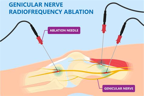 Genicular Nerve Block For Knee Pain | Advanced Surgery Center