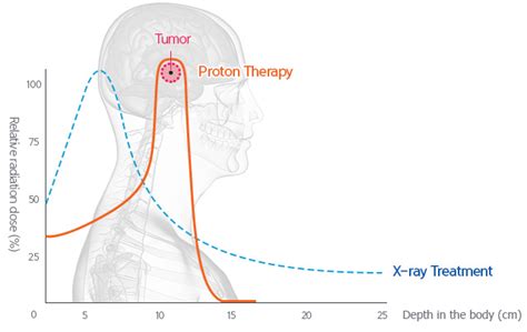 How it works - What is Proton Therapy? - SAMSUNG PROTON THERAPY CENTER