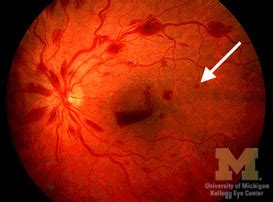 Diabetic retinopathy physical examination - wikidoc