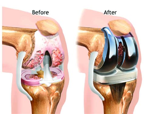 Knee Implants – How Long Do They Last | Dr. Santosh Shetty