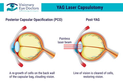 Understanding YAG Laser Capsulotomy: Clarity after Cataract Surgery