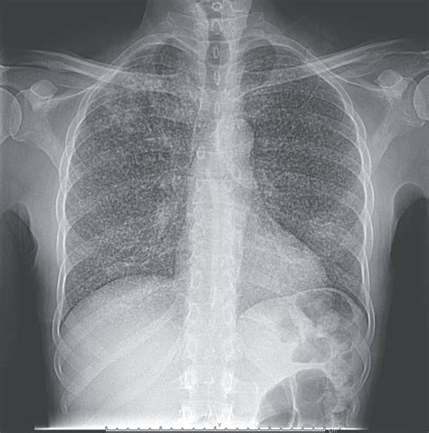 Tuberculosis X Ray - Difference Between Pneumonia And Tuberculosis ...