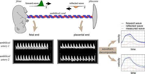 Wave reflections in the umbilical artery measured by Doppler ultrasound as a novel predictor of ...