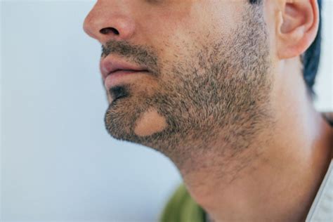 Alopecia Barbae & Its Effects On Your Beard