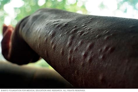 Poison ivy rash - Symptoms and causes - Mayo Clinic