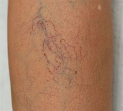 Spider Veins, Thread Veins & Reticular Veins Treatments Belfast — Varicose Vein Clinics