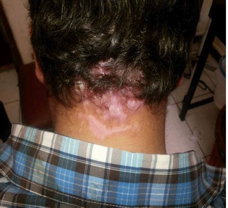 Comprehensive Review of Keloid Formation