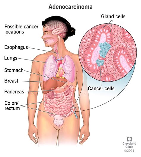 Carcinoma: Types, Treatment & What it Is