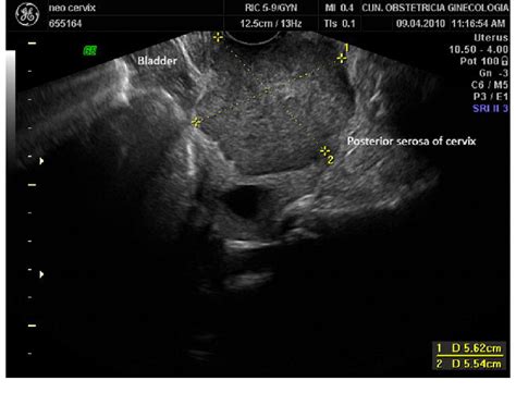 Uterine Cancer Ultrasound Images