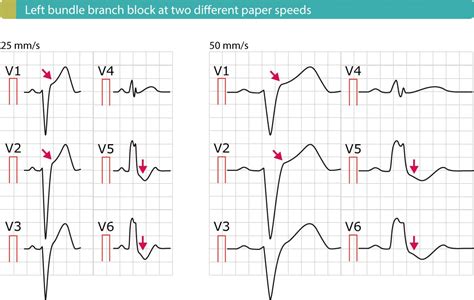 ST elevation myocardial infarction (STEMI) without ST elevations on 12-lead ECG – ECG learning