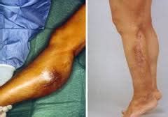 Soft Tissue Sarcoma | India| PDF | PPT| Case Reports | Symptoms | Treatment