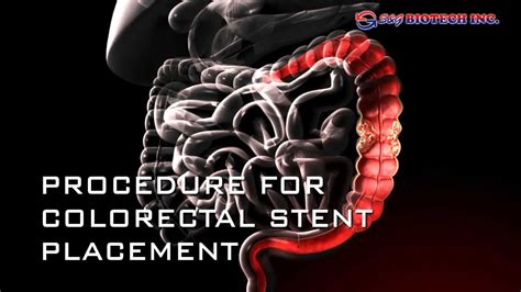 Colorectal Stent - YouTube