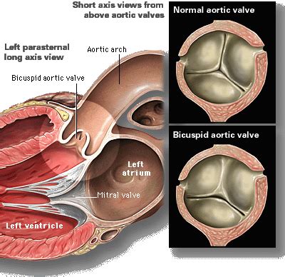 Bicuspid Aortic Valve Review | Learn the Heart