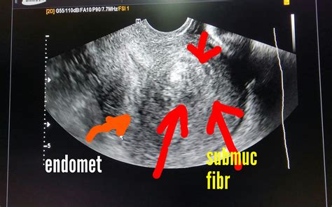 Ultrasound imaging: Submucosal-fibroid-vascular