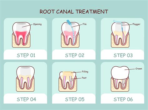 How long is root canal recovery?