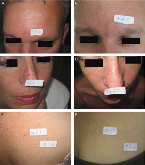 Figure 2 from A Comparative Study of Pulsed 532‐nm Potassium Titanyl Phosphate Laser and ...