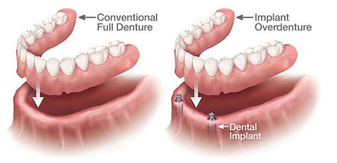 Dentures – Valley Dental Care