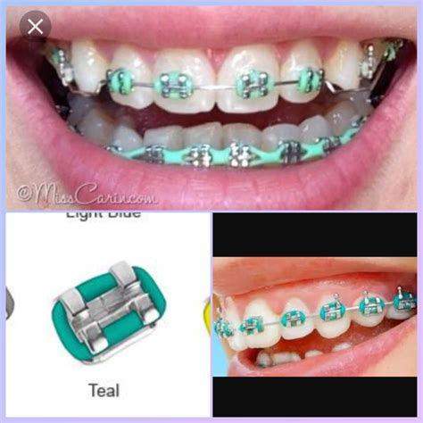 AHHH!! Guys which color? Teal or mint green? Plz let me know in the comments ASAP!!!! | Braces ...