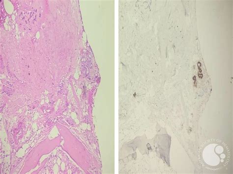 NON NEOPLASTIC GLANDS IN BONE MARROW TREPHINE BIOPSY 1