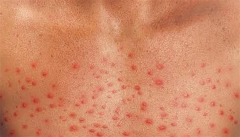 Cirrhosis Rash: Is Your Rash Caused By Hepatitis? - Fatty Liver Disease