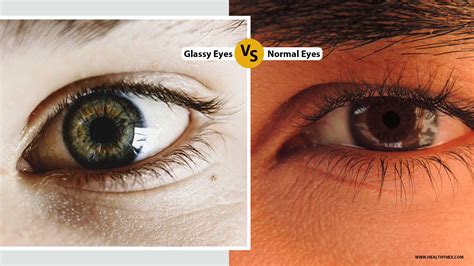 glassy eyes vs normal eyes - Captions Prince