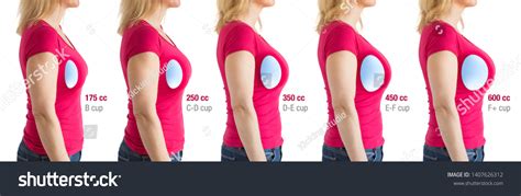 How Choose Breast Implants Different Types Stock Photo 1407626312 ...