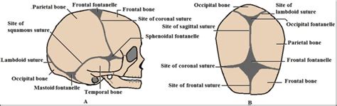 Newborns’ Cranial Vault: Clinical Anatomy and Authors’ Perspective - Open Access Pub